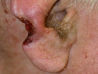 Morpheatype scleroserend basaalcelcarcinoom (histologisch sprieterig)