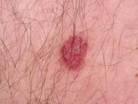 Superficial basal cell carcinoma
