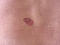 Superficial basal cell carcinoma