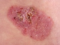 Superficial basal cell carcinoma