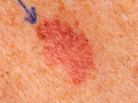 Superficieel basaalcelcarcinoom