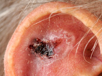 Ulcerative basal cell carcinoma