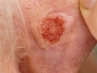 Ulcerative basal cell carcinoma