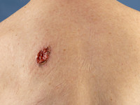 Ulcererend basaalcelcarcinoom