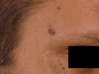 Basal cell nevus syndrome