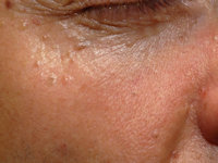 Basal cell nevus syndrome