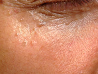 Basal cell nevus syndrome