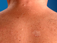 Basal cell nevus syndrome