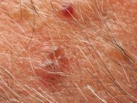 Basal cell nevus syndrome