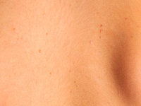 Basaalcelnaevus syndroom