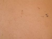 Basaalcelnaevus syndroom