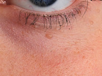 Basal cell nevus syndrome