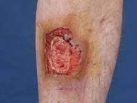 Basosquameus carcinoom