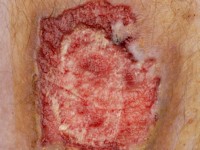 Basosquameus carcinoom