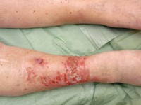 Basosquameus carcinoom