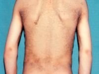 Bathing suit ichthyosis