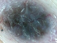 Branched vessels bij dermatoscopie