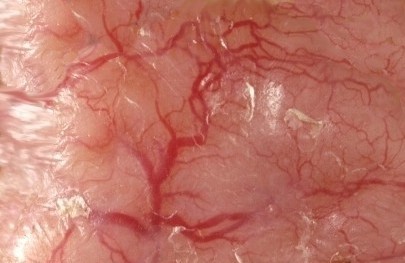 Arborizing vessels in een basaalcelcarcinoom