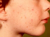 Benigne cefale histiocytose