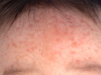 Benigne cefale histiocytose