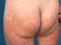 Benigne cefale histiocytose