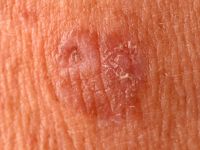 benign lichenoid keratosis