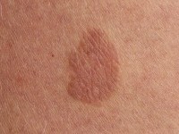 benign lichenoid keratosis