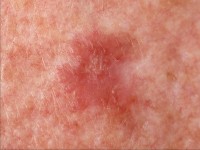 benign lichenoid keratosis