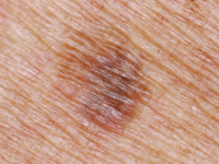 benigne lichenoide keratose