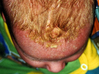 Berg, seborrhoea capitis neonatorum