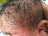 Berg, seborrhoea capitis neonatorum