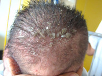 Berg, seborrhoea capitis neonatorum