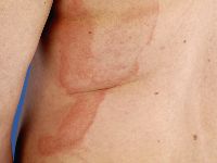 Berloque dermatitis