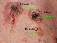 Waar moet ik het biopt afnemen bij verdenking pemphigus vulgaris ?
