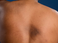 Biphasic amyloidosis