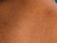 Biphasic amyloidosis