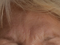 Birt-Hogg-Dubé syndroom