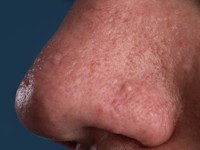 Birt-Hogg-Dubé syndroom