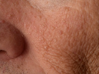 Birt-Hogg-Dubé syndroom