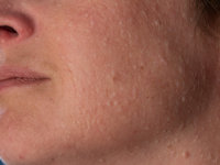 Birt-Hogg-Dubé syndroom