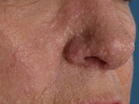 Birt-Hogg-Dubé syndroom