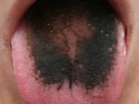 Black hairy tongue (lingua villosa nigra)