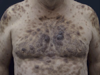 Blastair plasmacytoïd dendritische cel neoplasma (BPDCN) 