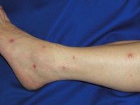 Bowel-associated dermatosis-arthritis syndrome