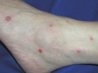 Bowel-associated dermatosis-arthritis syndrome