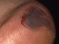 Bloedblaar (decubitus)