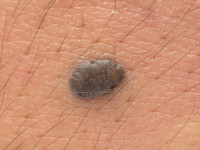 Blue nevus