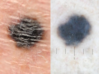 Blue nevus