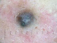 Blue nevus