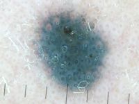 Blue nevus